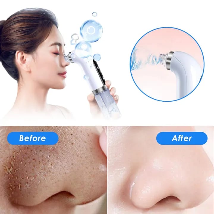 *Super Micro Bubble Beauty Instrument Black Head Remover*